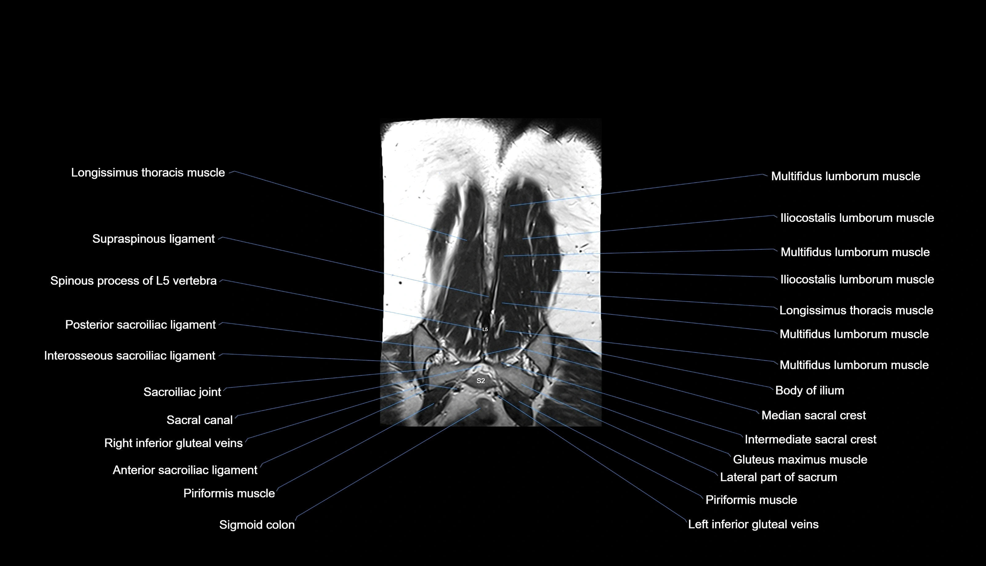 MRI lumbar spine labelled coronal cross sectional anatomy 3T radiology-img-00001-00035.webp